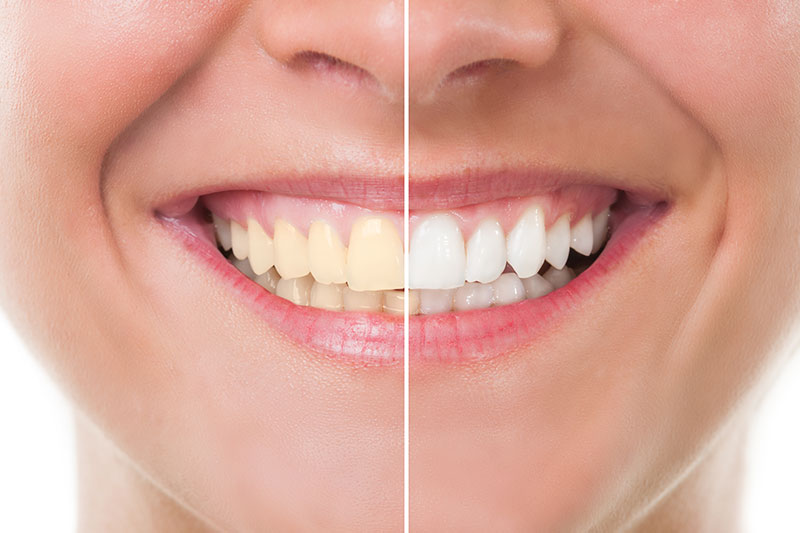 Teeth Whitening in Munster