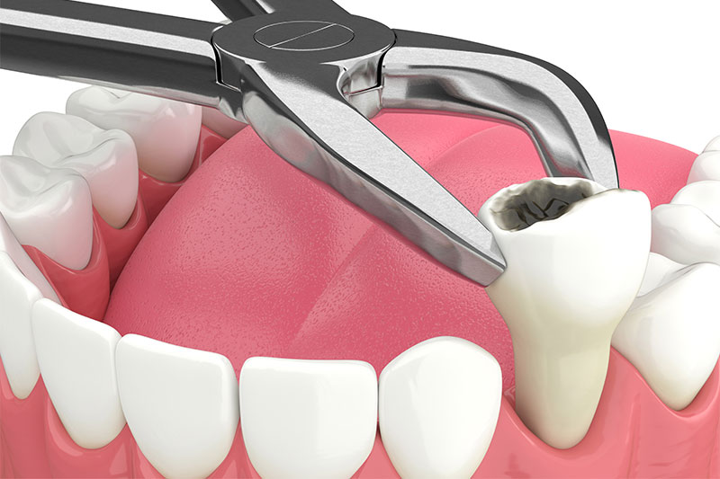Extraction Orthodontics in Munster