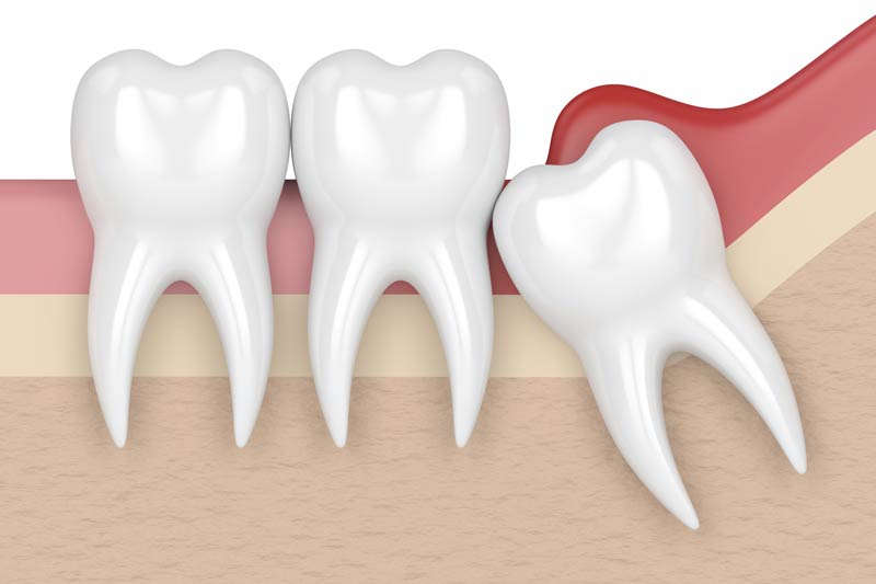 Wisdom Tooth Removal in Munster